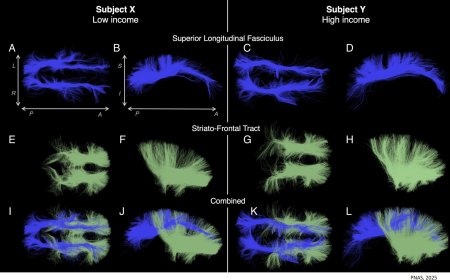 Brain white matter variation from childhood experiences affects cognition later