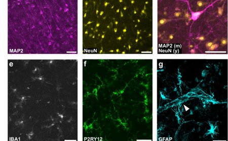 Role of physiological and pathological Aβ on synapses in human brain tissue