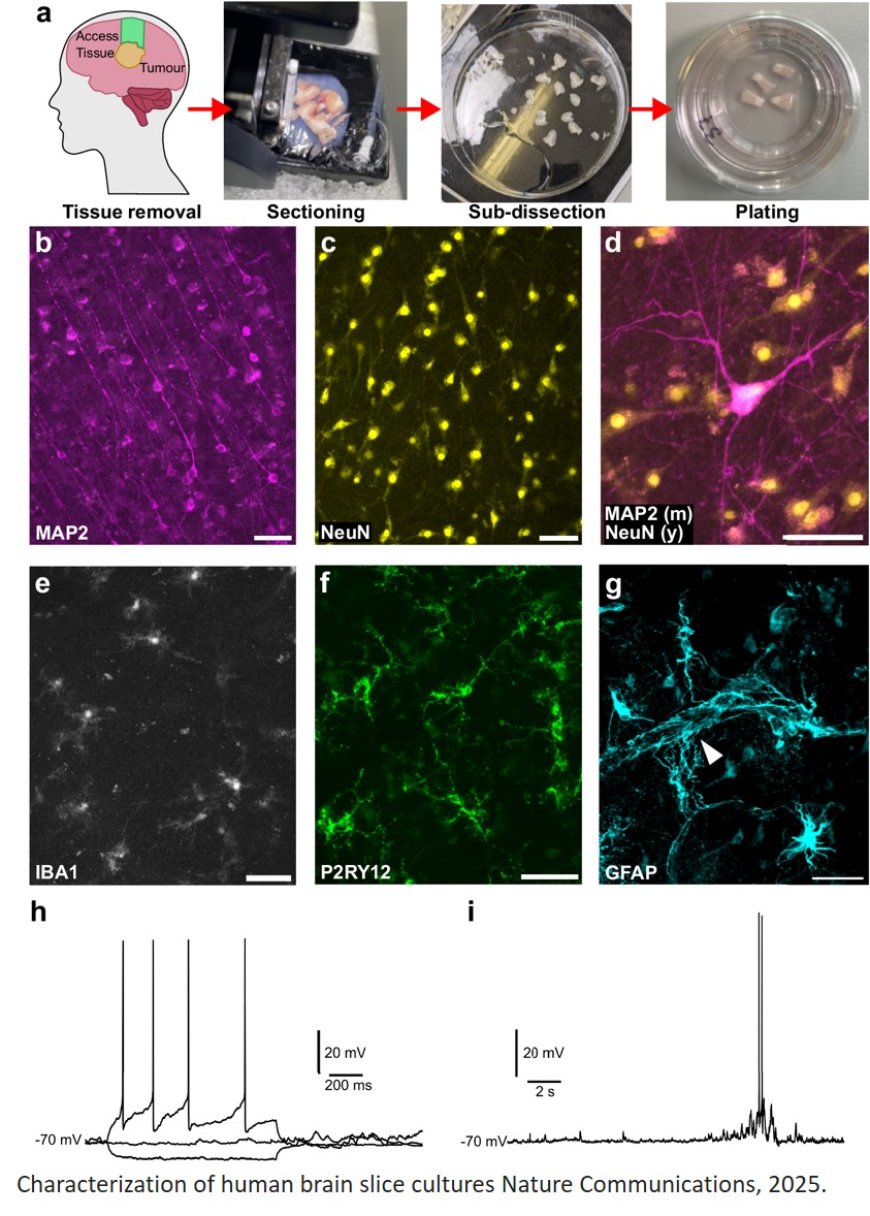Role of physiological and pathological Aβ on synapses in human brain tissue