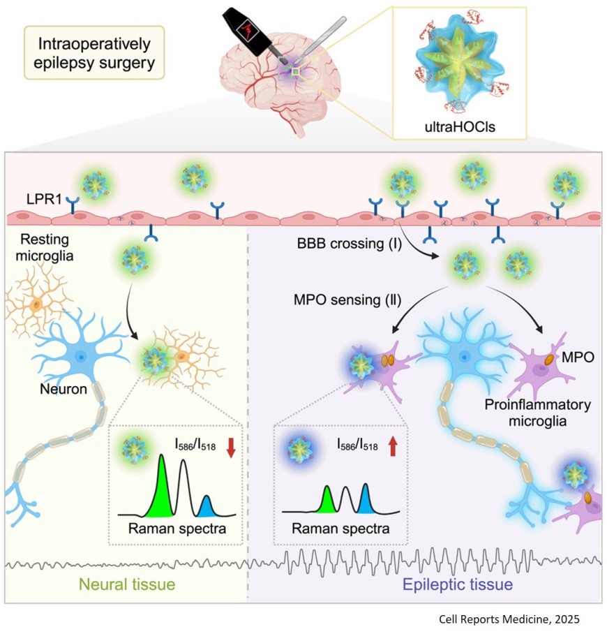 Ultrabright ratiometric Raman-guided epilepsy surgery by intraoperatively visualizing proinflammatory microglia