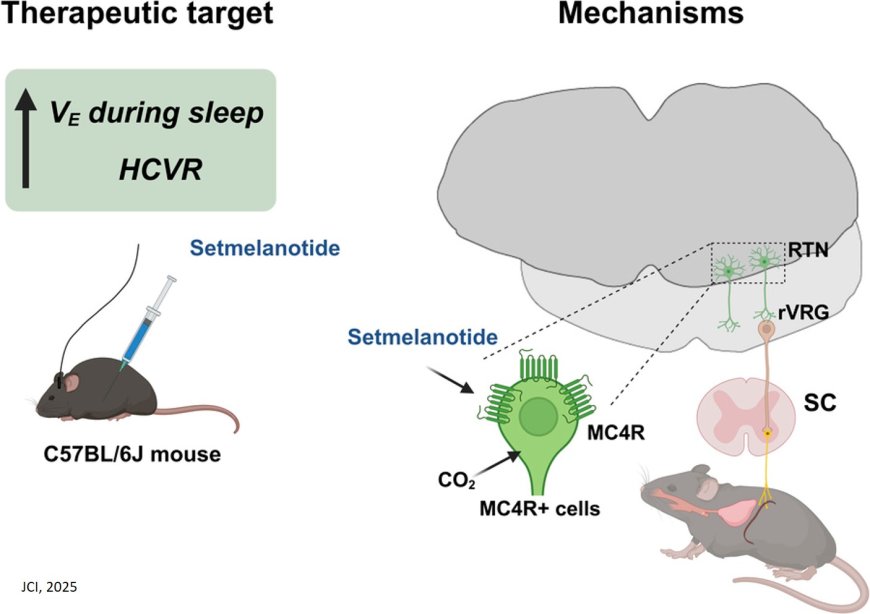 A potential treatment for obesity-linked breathing disorder