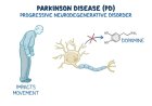 PARKINSON’S DISEASE