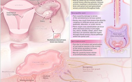 What is Endometriosis?