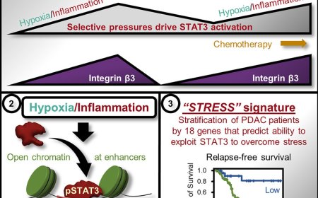 Gene signature an early warning system for aggressive pancreatic cancer