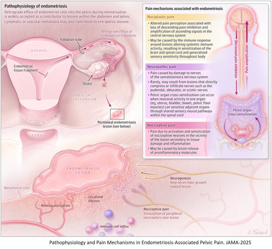 Endometriosis