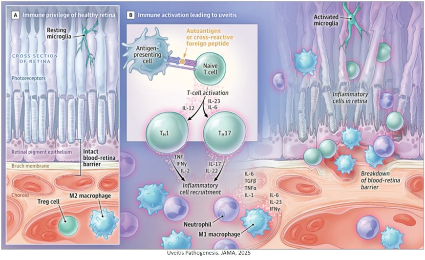 Uveitis in Adults