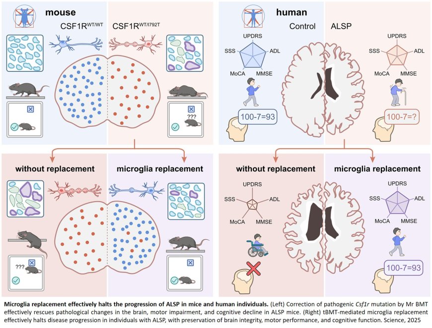 Microglia replacement halts the progression of microgliopathy in mice and humans