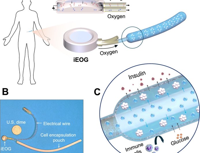 Implant treats Type 1 diabetes by oxygenating insulin-producing cells