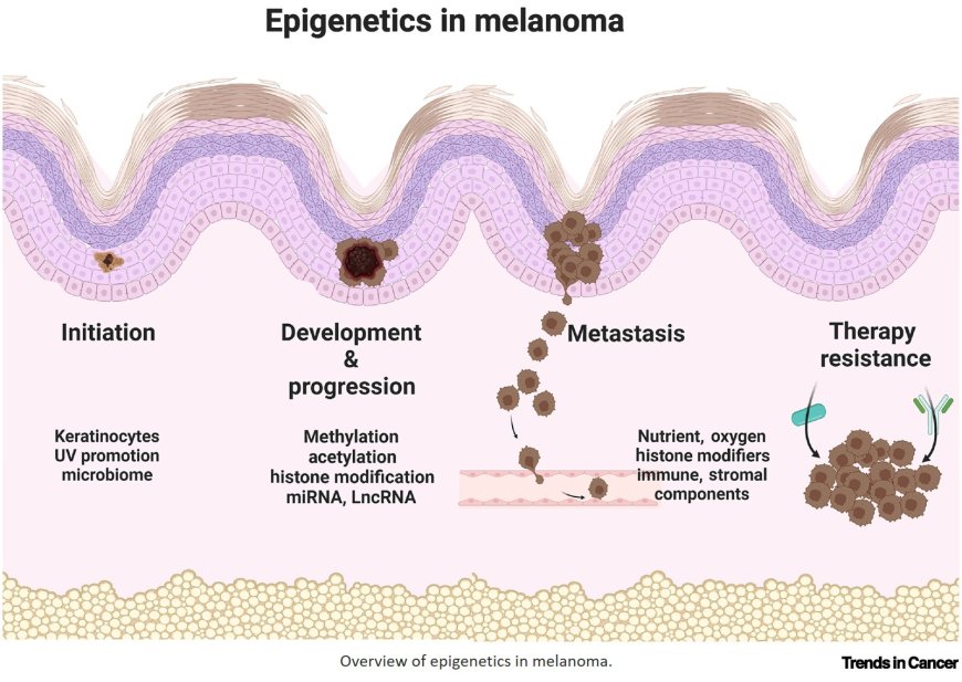 Epigenetic mechanisms in melanoma development and progression