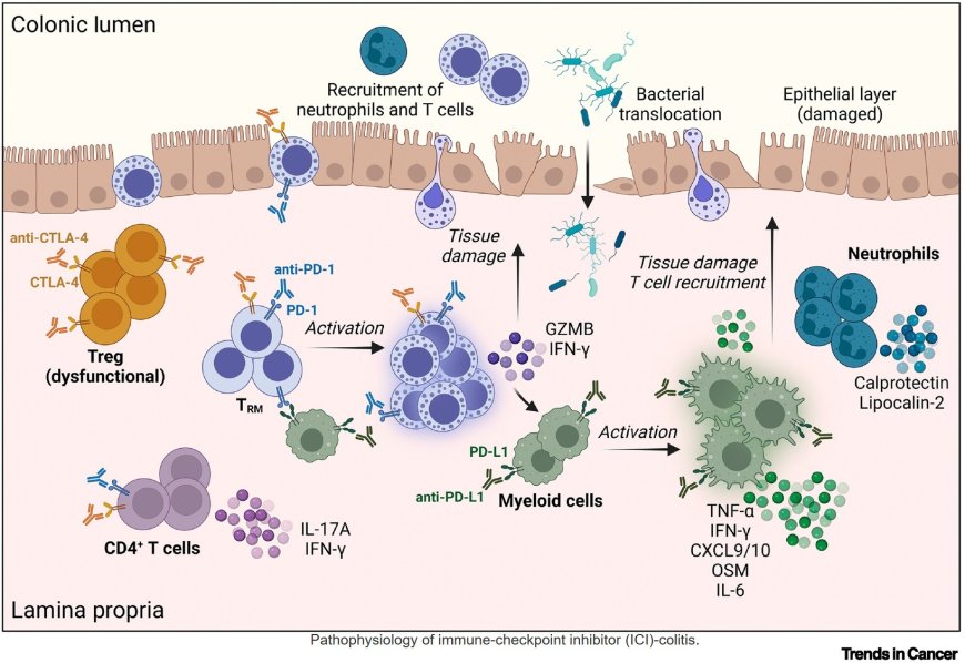Clinical perspective and treatment of immune-related colitis after cancer immunotherapy