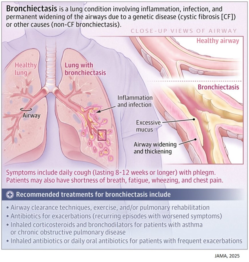 What Is Bronchiectasis?