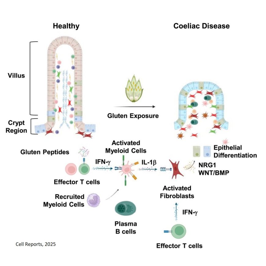 Immune signaling mediates stromal changes to support epithelial reprogramming in celiac duodenum