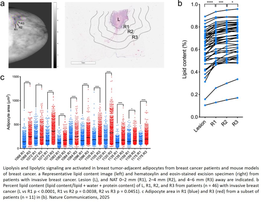 Tumor cell-adipocyte gap junctions activate lipolysis and contribute to breast tumorigenesis