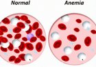 Anemia