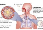 Tuberculosis