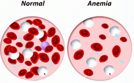 Anemia