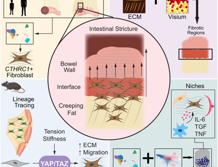 ‘Creeping fat’ can worsen Crohn’s disease