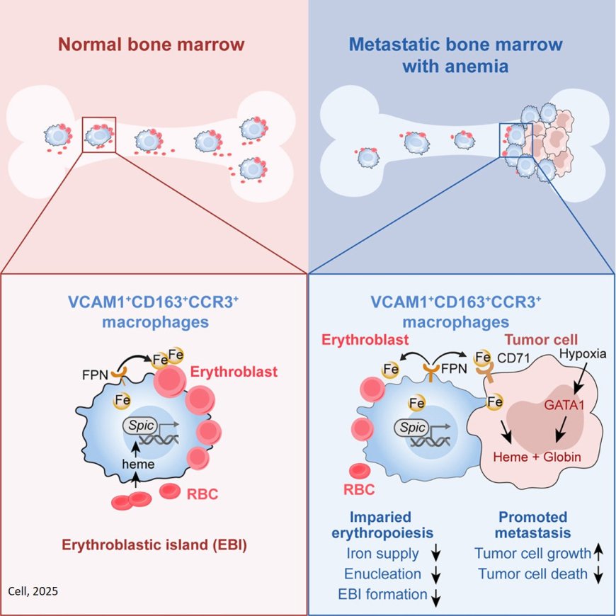 Tumors hijack macrophages for iron supply to promote bone metastasis and anemia