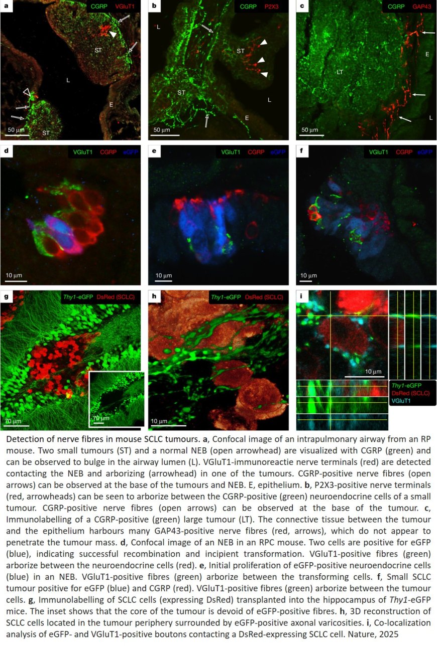 How small cell lung cancer hijacks neuronal synapses