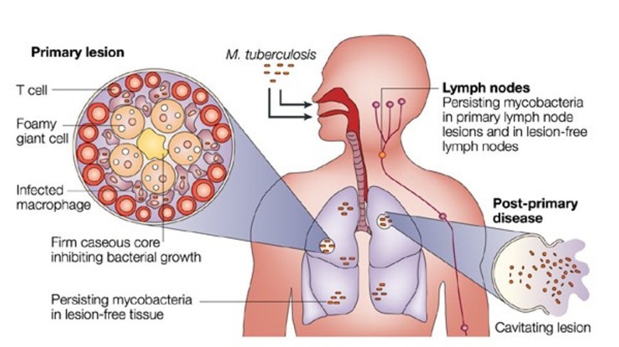 Tuberculosis