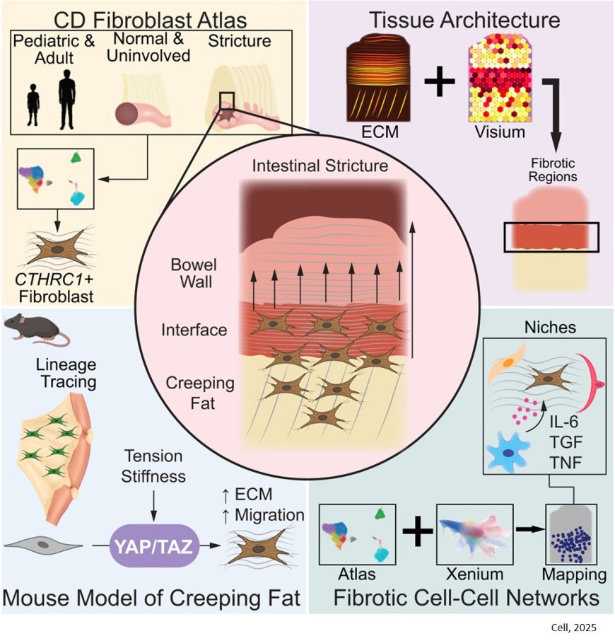 ‘Creeping fat’ can worsen Crohn’s disease