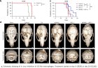Glioblastomas affect much more than just the brain