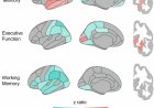 Brain’s shifting geometry tied to memory loss, dementia risk