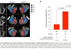 Myocardial reprogramming by HMGN1 underlies heart defects in trisomy 21