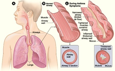 What is Asthma