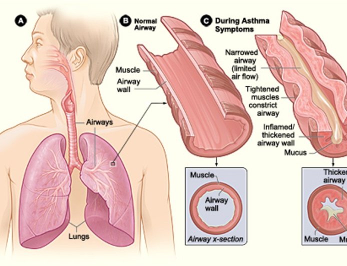What is Asthma