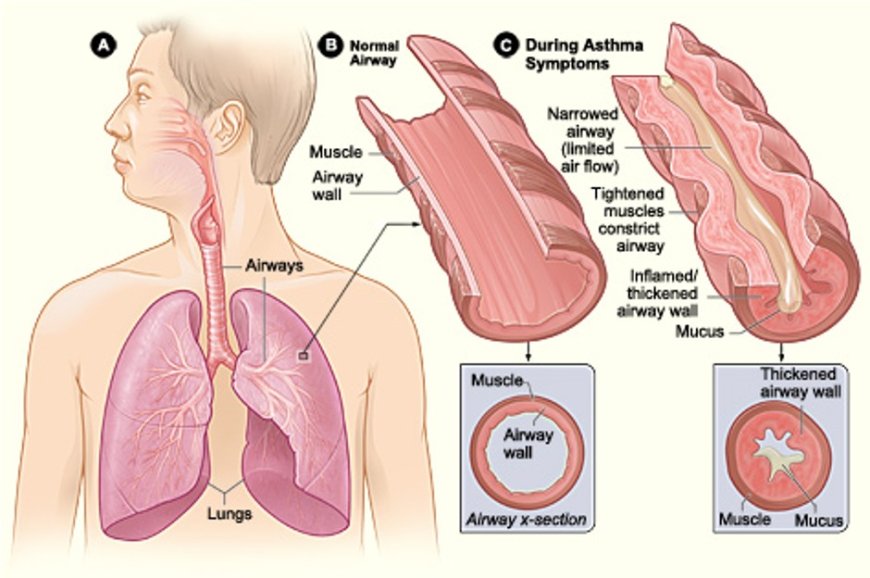 What is Asthma