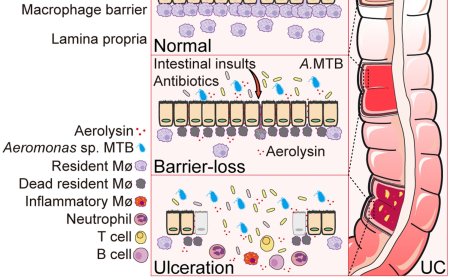 Toxic gut bacteria may drive ulcerative colitis 