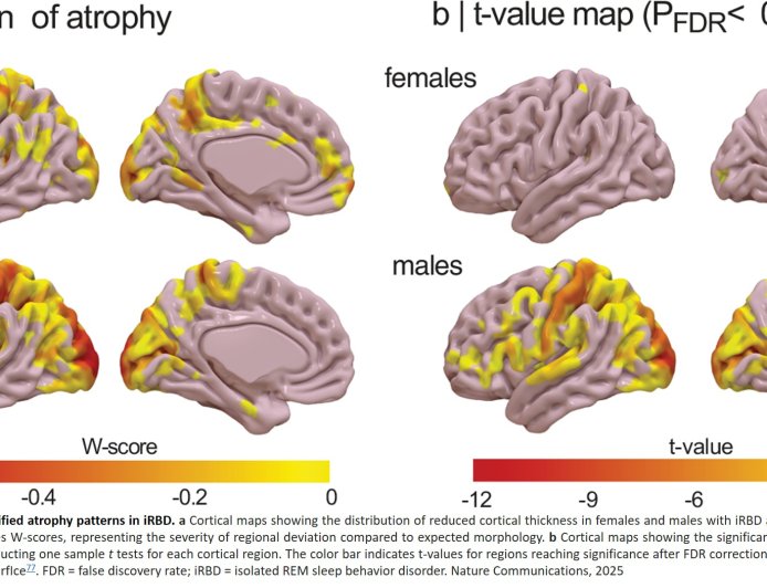 Women better protected against early neurodegeneration in Parkinson's disease