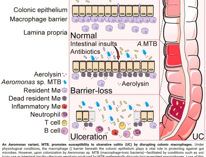 Toxic gut bacteria may drive ulcerative colitis 