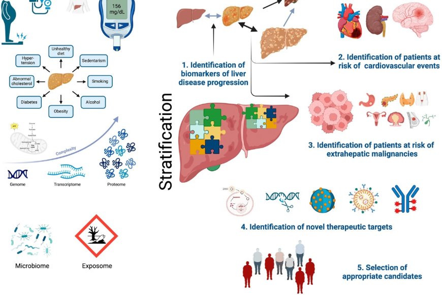 Treating metabolic dysfunction-associated steatotic liver disease with precision medicine