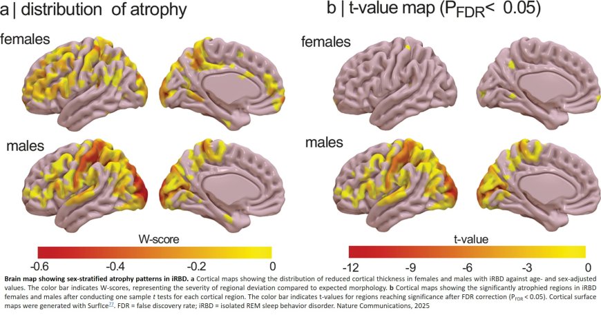 Estrogen-related receptor gene expression associates with sex differences in cortical atrophy in isolated REM sleep behavior disorder