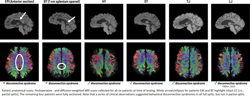 A few fibres enable communication between the two hemispheres of the brain