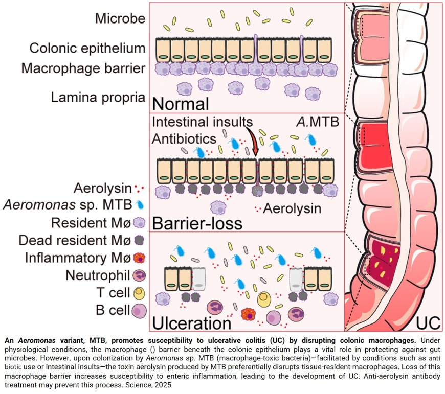 Toxic gut bacteria may drive ulcerative colitis 