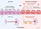 Cerebrospinal fluid-driven ependymal motile cilia defects are implicated in multiple sclerosis