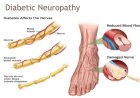Diabetic Neuropathy