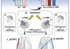 Frontoparietal network mediates the antidepressant effects of accelerated iTBS and cTBS: TMS-EEG study