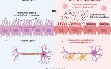 Cerebrospinal fluid-driven ependymal motile cilia defects are implicated in multiple sclerosis