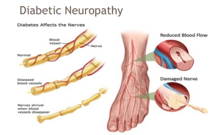 Diabetic Neuropathy