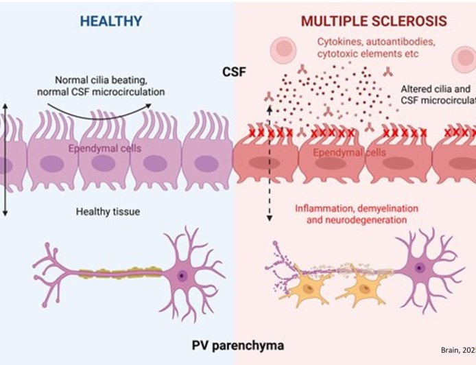 Cerebrospinal fluid-driven ependymal motile cilia defects are implicated in multiple sclerosis