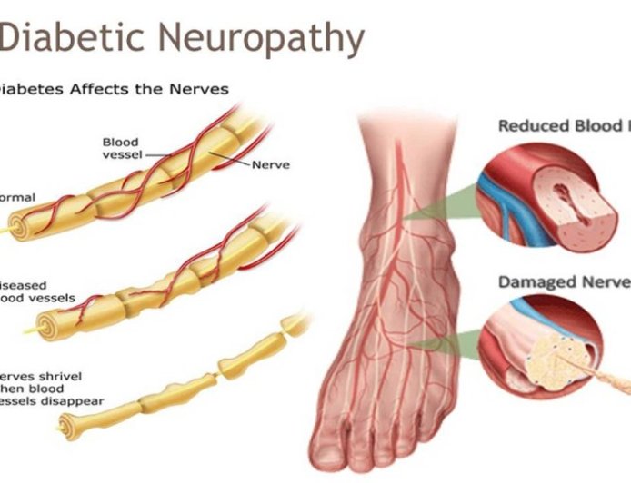 Diabetic Neuropathy