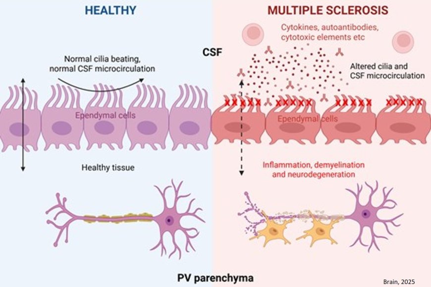 Ependymal motile cilia defects are implicated in multiple sclerosis
