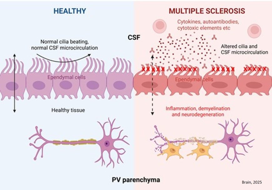Cerebrospinal fluid-driven ependymal motile cilia defects are implicated in multiple sclerosis